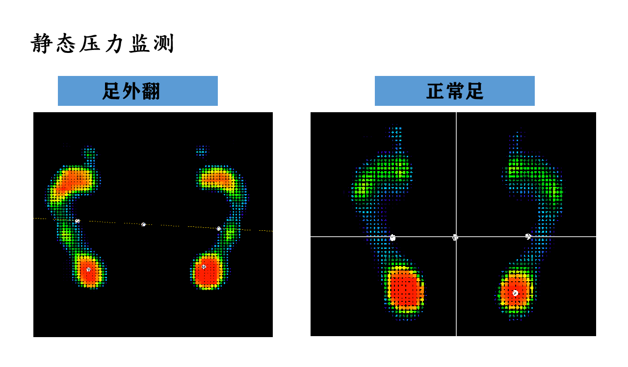 【同德科普】预防糖尿病足，别忘测足底压力——帮您认识糖尿病足（二）(图5)