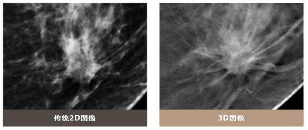 女性体检新选择——三维断层乳腺X线摄影（钨靶）(图3)